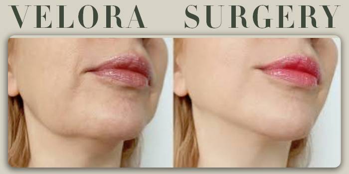 آیا ساکشن غبغب باعث زاویه_سازی فک (Jawline) می_شود؟