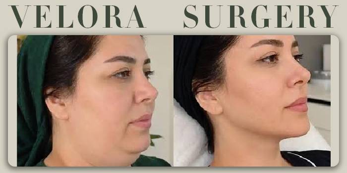 چرا باید قبل از عمل، نمونه کارهای جراحی غبغب و کانتورینگ را ببینیم؟