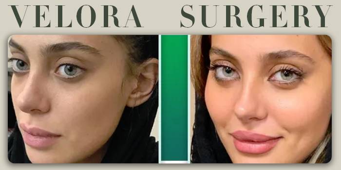 در دنیای امروز که زمان برای بسیاری از افراد حکم طلا را دارد، تقاضا برای «عمل‌های ترکیبی» یا Combo Surgery به‌شدت افزایش یافته است. بسیاری از افرادی که تصمیم به انجام سوپر کانتورینگ بدن برای حذف چربی‌های مقاوم و فرم‌دهی عضلانی می‌گیرند، مایلند همزمان با رفع چربی‌های بدن، دغدغه‌هایی مانند غبغب، افتادگی‌های ظریف صورت یا عدم تقارن خط فک را نیز اصلاح کنند. اما سوال اساسی اینجاست: آیا ترکیب کانتورینگ صورت و بدن در یک جلسه جراحی امکان‌پذیر و ایمن است؟ در این مقاله تخصصی، به بررسی علمی این موضوع، مزایا و ملاحظات حیاتی آن می‌پردازیم. جراحی ترکیبی (Combo Surgery) چیست؟ جراحی ترکیبی به معنای انجام بیش از یک پروسیجر زیبایی در یک نوبت بیهوشی است. در اینجا، منظور ترکیب روش‌های «پیکرتراشی پیشرفته» (مانند سوپر کانتورینگ که روی ابعاد بدن تمرکز دارد) با روش‌های «کانتورینگ صورت» (مانند ساکشن غبغب، لیفت صورت، یا تزریق چربی) است. پاسخ کوتاه به این سوال که آیا این کار ممکن است؟ بله، اما با رعایت پروتکل‌های دقیق ایمنی. مزایای انجام همزمان کانتورینگ صورت و بدن بسیاری از بیماران برای صرفه‌جویی در زمان و هزینه‌های جانبی، ترجیح می‌دهند تغییرات خود را در یک مرحله به پایان برسانند. مهم‌ترین مزایای این رویکرد عبارتند از: ۱. یک‌بار بیهوشی، یک‌بار نقاهت بزرگترین مزیت، عبور از یک دوره نقاهت است. به جای اینکه بیمار دو بار در فواصل زمانی مختلف تحت عمل جراحی قرار بگیرد، با یک بار جراحی، کل پروسه ریکاوری را پشت سر می‌گذارد. این موضوع برای افراد پرمشغله یک مزیت بزرگ محسوب می‌شود. ۲. صرفه‌جویی در هزینه‌های بیمارستانی هزینه‌های جانبی جراحی، از جمله هزینه اتاق عمل، تیم بیهوشی و بستری، بخش قابل‌توجهی از بودجه را تشکیل می‌دهند. با انجام همزمان، این هزینه‌ها تنها یک بار پرداخت می‌شود که از نظر اقتصادی بسیار به‌صرفه‌تر است. ۳. رسیدن به هارمونی کامل وقتی جراح به صورت همزمان روی فرم بدن و کانتور صورت کار می‌کند، می‌تواند به یک «هارمونی» کلی در پیکره‌بندی شما برسد. برای مثال، اگر هدف بیمار رسیدن به اندام ساعت‌شنی است، لاغری بدن بدون اصلاح غبغب یا زاویه فک، شاید نیمه کاره به نظر برسد. جراحی همزمان کمک می‌کند تا نتیجه نهایی، یکپارچه‌تر و متناسب‌تر باشد. ملاحظات ایمنی؛ چه زمانی جراحی ترکیبی توصیه نمی‌شود؟ اگرچه جراحی ترکیبی جذاب است، اما امنیت بیمار اولویت مطلق است. جراح پلاستیک قبل از تایید این نوع عمل، چندین فاکتور مهم را بررسی می‌کند: مدت زمان جراحی: یکی از خطرات جراحی‌های طولانی، طولانی شدن مدت بیهوشی است. اگر مجموع زمان عمل برای صورت و بدن از حد استانداردی (معمولاً بیش از ۵ تا ۶ ساعت) فراتر رود، ریسک عوارض بیهوشی و لخته شدن خون افزایش می‌یابد. وضعیت جسمانی: بیمار باید از سلامت عمومی کامل برخوردار باشد. اگر بیمار مبتلا به کم‌خونی، فشار خون یا مشکلات قلبی-عروقی باشد، انجام همزمان این عمل‌ها توصیه نمی‌شود. تخصص جراح: این پروسیجر نیازمند تیمی است که در مدیریت همزمان چندین ناحیه تخصص داشته باشد. کانتورینگ بدن و صورت تکنیک‌های متفاوتی دارند و جراح باید در هر دو زمینه مهارت فوق‌تخصصی داشته باشد. چه روش‌هایی را می‌توان با هم ترکیب کرد؟ معمولاً ترکیب‌های زیر در جراحی‌های زیبایی بسیار رایج و موفق هستند: سوپر کانتورینگ شکم و پهلو با ساکشن غبغب: ساده‌ترین و ایمن‌ترین ترکیب است زیرا زمان جراحی غبغب کوتاه است و تداخل چندانی با جراحی بدن ندارد. پیکرتراشی ۳۶۰ درجه با لیفت صورت: این ترکیب سنگین‌تر است و تنها برای افرادی که شرایط جسمانی ایده‌آلی دارند توصیه می‌شود. پیکرتراشی و انتقال چربی (Fat Grafting): جراح می‌تواند چربی‌های تخلیه شده از بدن را پس از تصفیه، برای فرم‌دهی به صورت یا گونه‌ها استفاده کند که یک روش فوق‌العاده برای جوانی چهره و تناسب اندام است. آماده‌سازی برای جراحی ترکیبی اگر شما و جراح‌تان تصمیم به انجام جراحی همزمان گرفتید، آمادگی قبل از عمل بسیار حیاتی‌تر از جراحی‌های تک‌ناحیه‌ای است: آزمایش‌های جامع: آزمایش‌های خون، ارزیابی قلبی و بررسی میزان سطح آهن و ویتامین‌ها برای اطمینان از بهبودی سریع بدن. ترک سیگار و دخانیات: حداقل ۴ هفته قبل از عمل باید مصرف هرگونه دخانیات متوقف شود تا گردش خون برای ترمیم نواحی وسیع (صورت و بدن) بهینه باشد. برنامه‌ریزی برای دوران نقاهت: به دلیل اینکه همزمان صورت و بدن شما تحت عمل قرار گرفته، نیاز به کمک در منزل برای ۵ تا ۷ روز اول دارید. سوالات متداول (FAQ) ۱. آیا درد ناشی از عمل همزمان زیاد است؟ درد برای هر ناحیه متفاوت است. معمولاً کانتورینگ بدن به دلیل وسعت ناحیه، نیاز به مدیریت درد بیشتری دارد، در حالی که ساکشن غبغب درد بسیار کمی دارد. استفاده از مسکن‌های استاندارد، این درد را کاملاً قابل مدیریت می‌کند. ۲. کدام جراحی‌ها را نباید همزمان انجام داد؟ جراحی‌هایی که نیازمند موقعیت‌های فیزیکی متفاوت روی تخت جراحی هستند (مثلاً یکی نیاز به خوابیدن روی شکم و دیگری روی کمر دارد) یا جراحی‌هایی که در نواحی عفونی انجام می‌شوند، نباید ترکیب شوند. ۳. دوره نقاهت جراحی ترکیبی چقدر طول می‌کشد؟ به‌طور کلی، دوره نقاهت شما به اندازه‌ی طولانی‌ترین پروسه جراحی خواهد بود. اگر سوپر کانتورینگ بدن انجام داده‌اید، همان دوره نقاهت ۴ تا ۶ هفته‌ای برای شما در نظر گرفته می‌شود، حتی اگر صورت شما در همان هفته دوم کاملاً بهبود یافته باشد. ۴. آیا می‌توان چربی تخلیه شده از شکم را به صورت تزریق کرد؟ بله، این یکی از هوشمندانه‌ترین کاربردهای جراحی ترکیبی است. چربی اتولوگ (خود فرد) بهترین فیلر برای جوانسازی صورت است که هیچ واکنش آلرژیکی ندارد. جمع‌بندی ترکیب کانتورینگ صورت و سوپر کانتورینگ بدن، یک روش پیشرفته برای کسانی است که می‌خواهند یک تحول کلی در ظاهر خود ایجاد کنند. با این حال، کلید موفقیت در این روش، انتخاب جراح متخصص و باتجربه است که بداند کجا باید مرز ایمنی را رعایت کند. کانتورینگ صورت و گردن همزمان با سوپر کانتورینگ بدن ممکن است؟